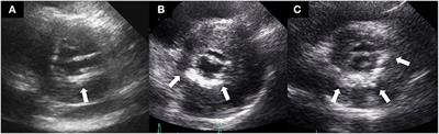 Sex Differences in Mitral Annular Calcification and the Clinical Implications